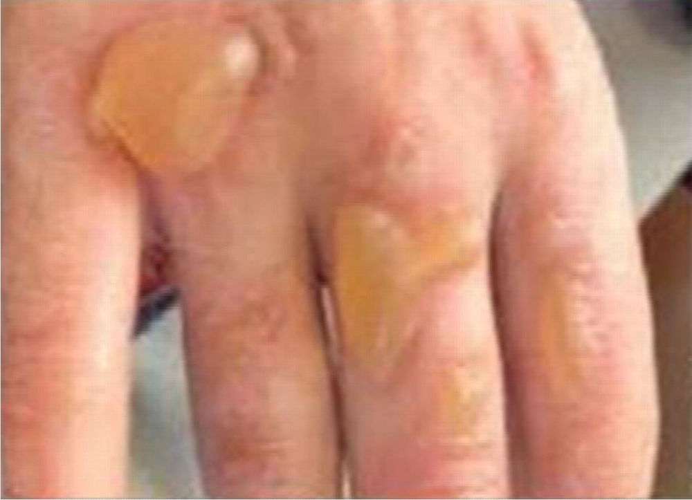 Second Degree burns caused by alcohol hand gel igniting